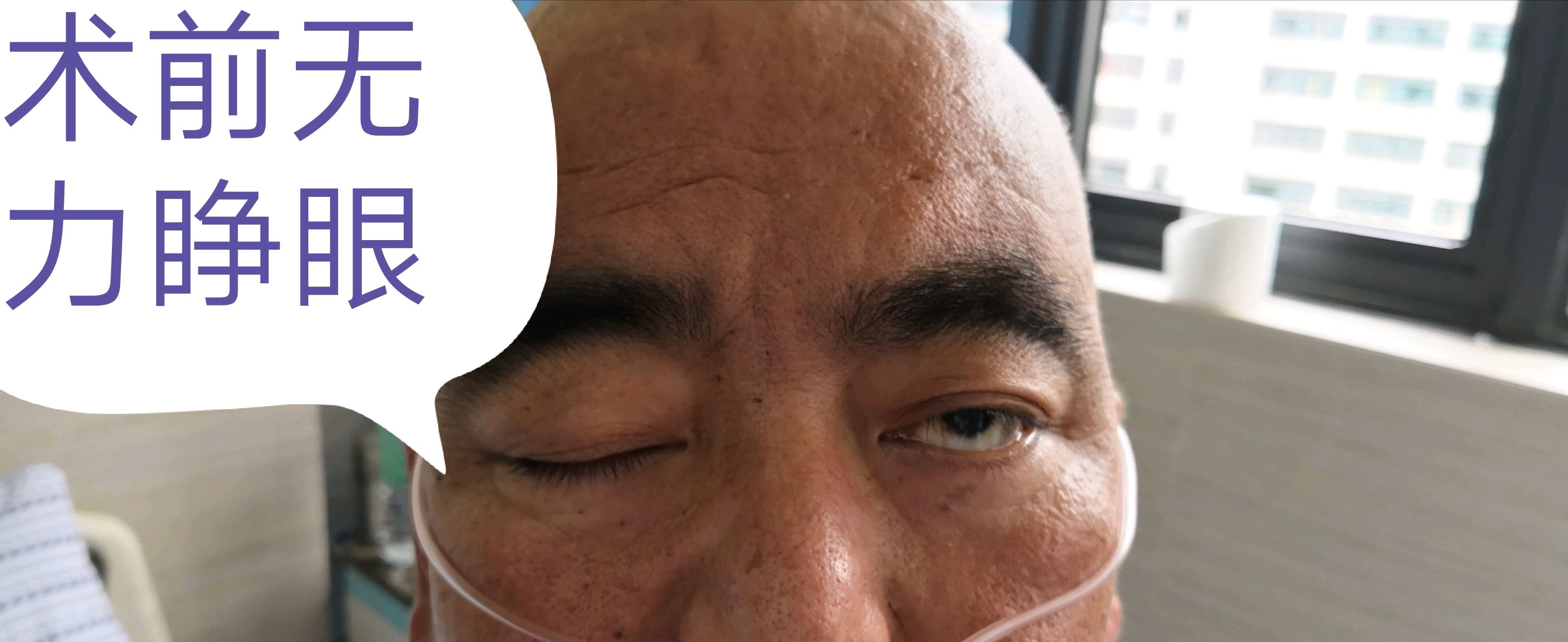重症肌无力做手术有用吗?看看微创手术前后对比!