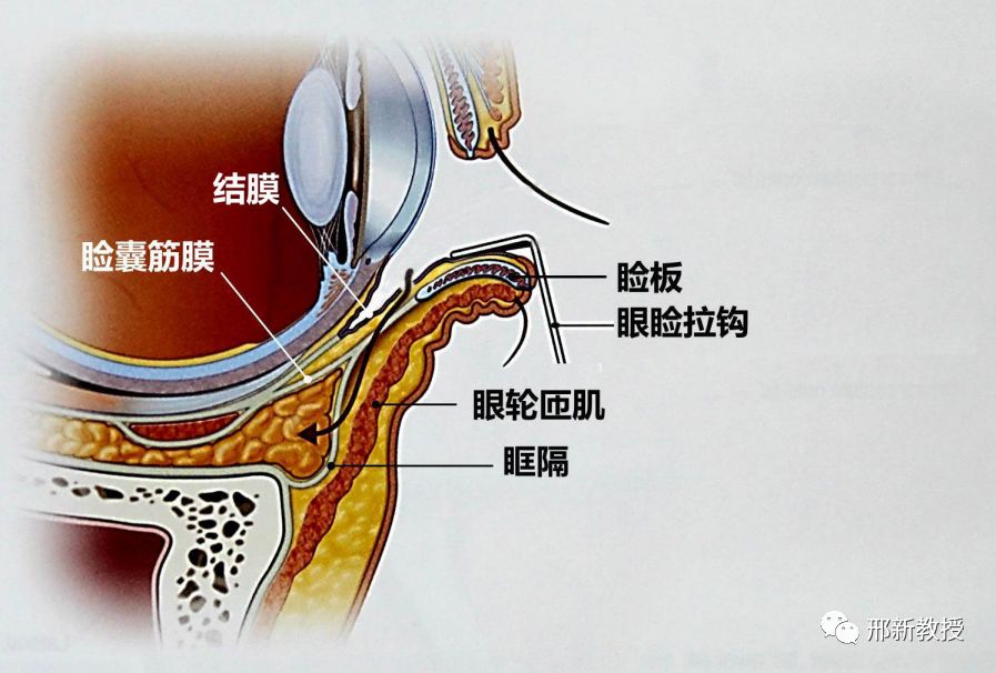 泪前隐窝入路手术步骤图片