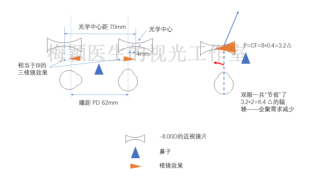 斜视双套环缝线示意图图片