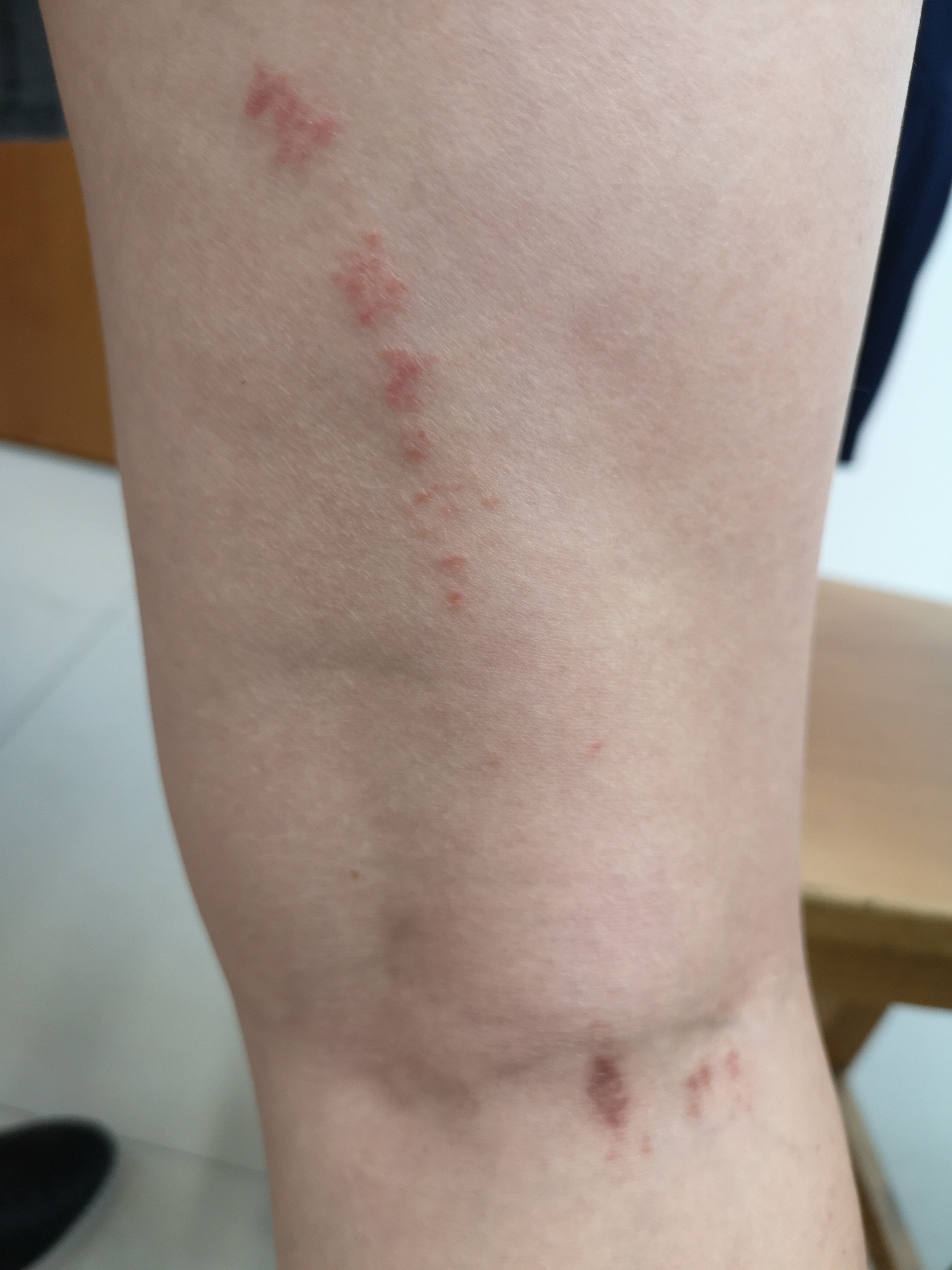 扁平苔藓变形记