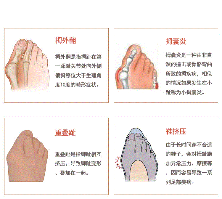 脚趾外翻怎么治疗图片