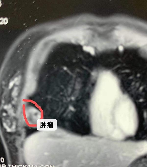 肋骨肿瘤恶性的图片图片