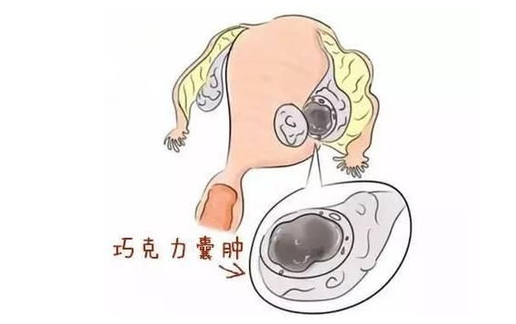 什么是卵巢巧克力囊肿