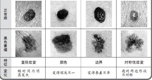 皮肤癌是遗传的?紫外线是帮凶?