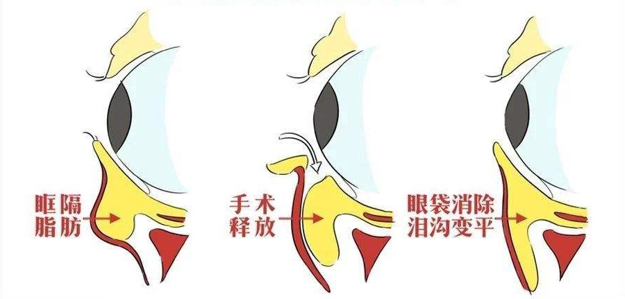 张宗学下睑眶隔脂肪释放术手术示意图