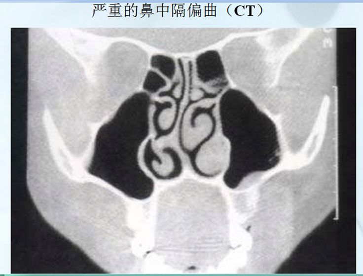 鼻中隔偏曲_乐玉朋_住院医师_爱问健康