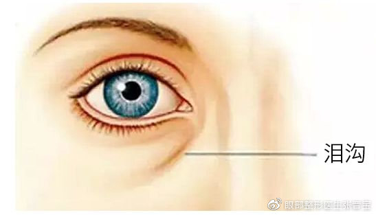 你为什么有泪沟了?眼袋和泪沟很严重如何解决?_张晋宝__爱问健康