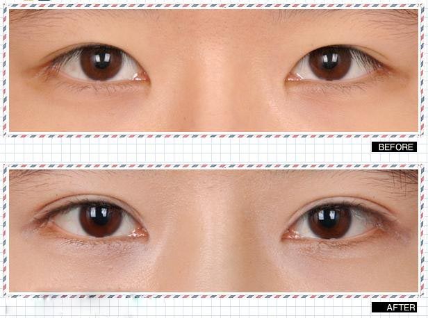 双眼皮前后对比.jpg