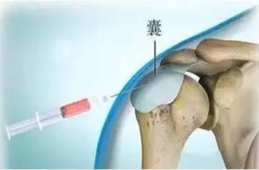 为什么要打封闭针?对身体有啥危害吗?_邱俏峰_主治医师_爱问健康