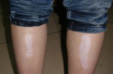 如果腿上出现白癜风就要注意这两点