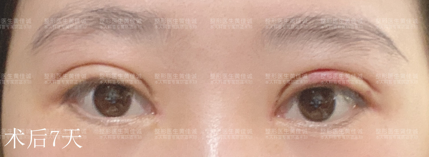 术后7天_副本.jpg