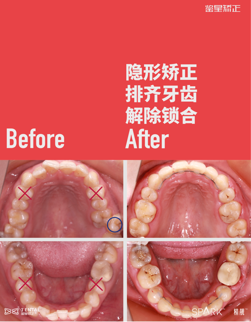 牙齿锁颌是什么情况有影响吗