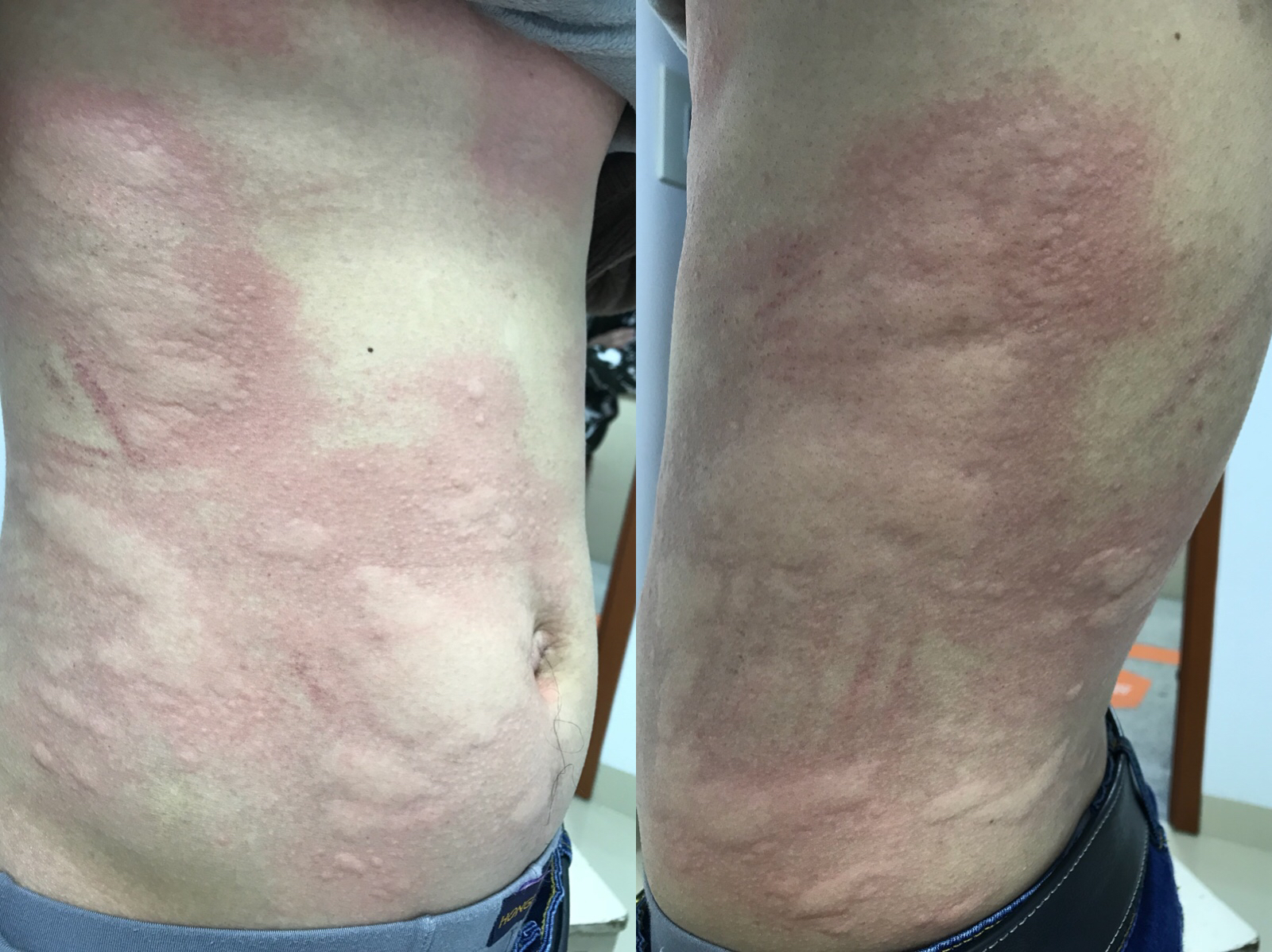 荨麻疹_林小清_主治医师_爱问健康