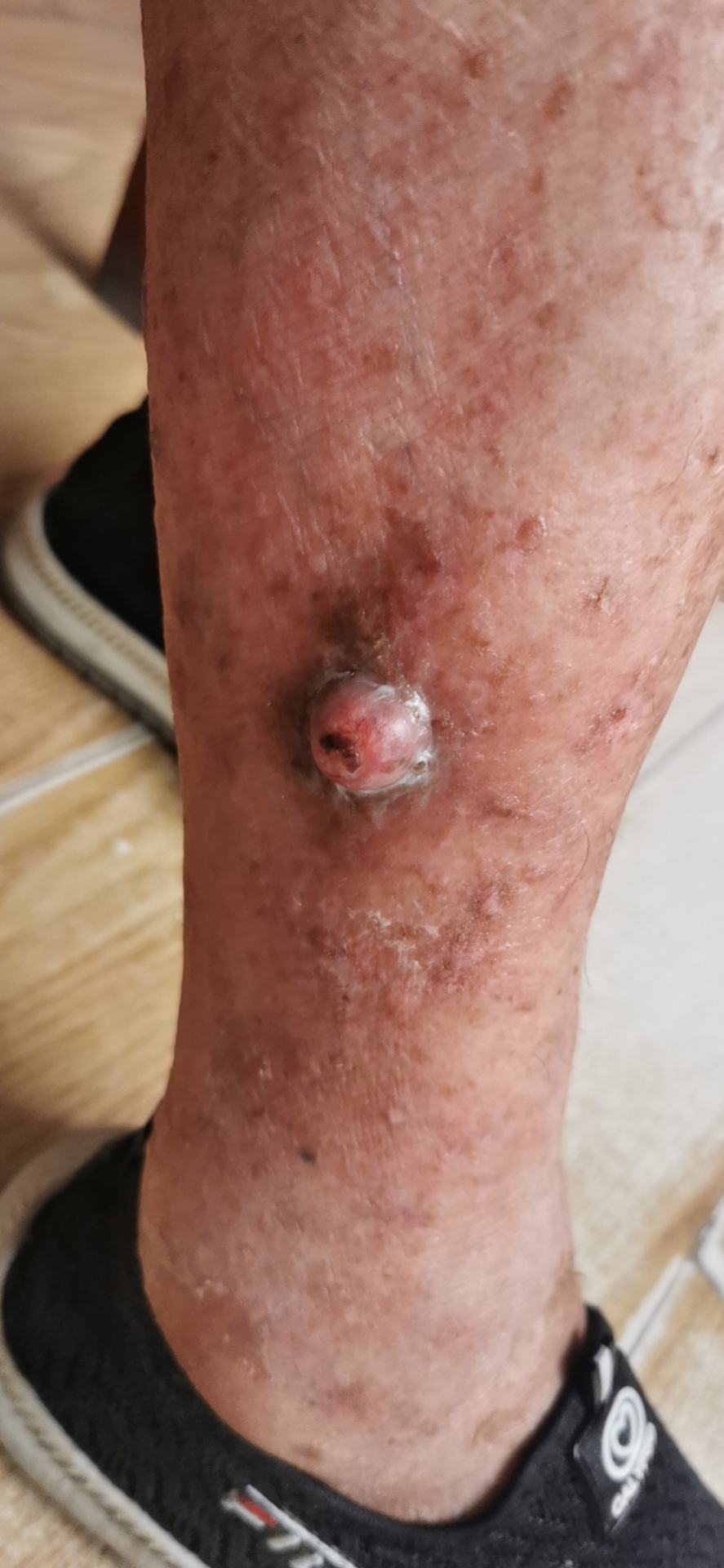 各不相同的皮肤癌_朱敏刚_主任医师_爱问健康