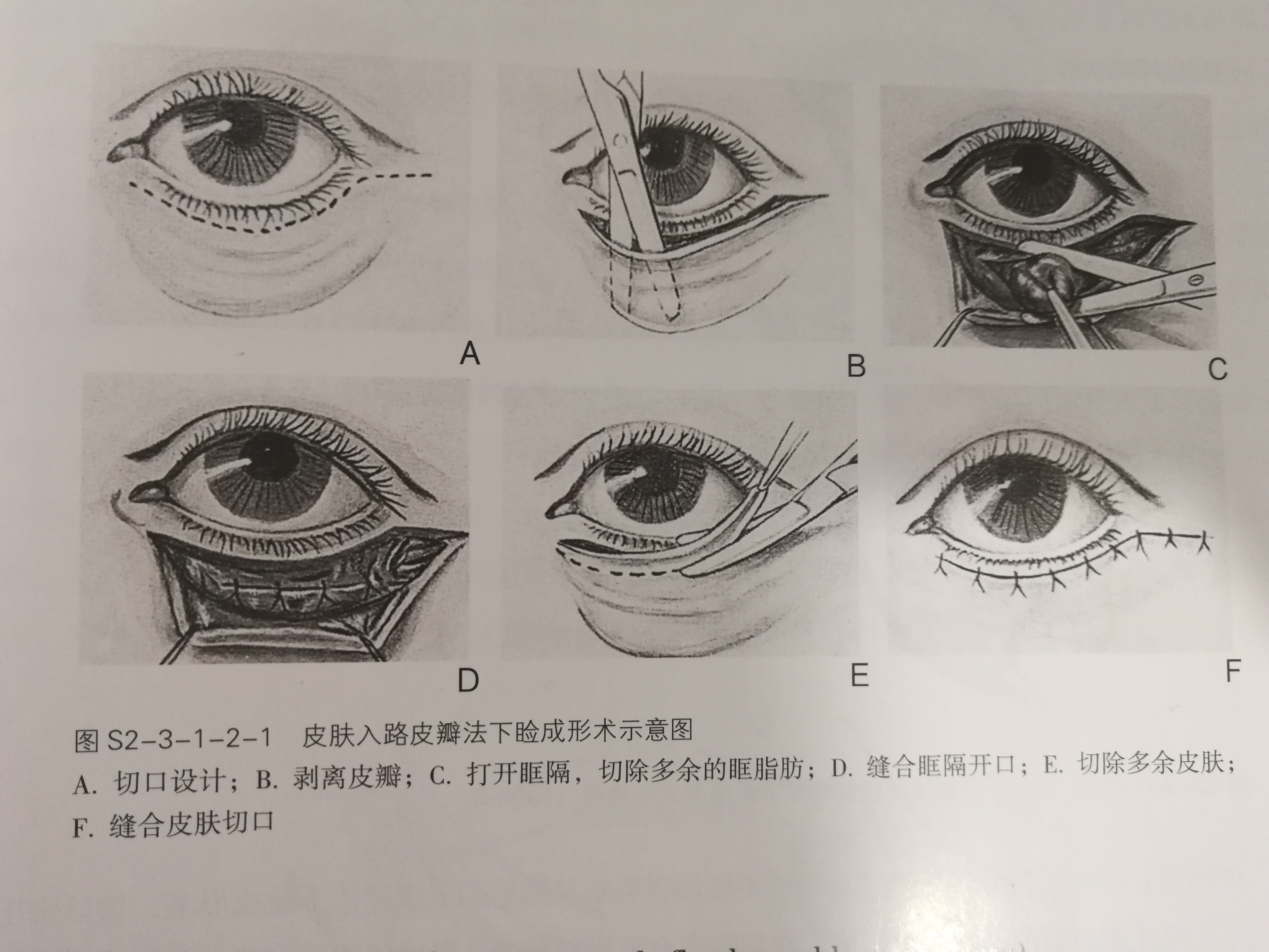 睑缘肿物切除术图解图片