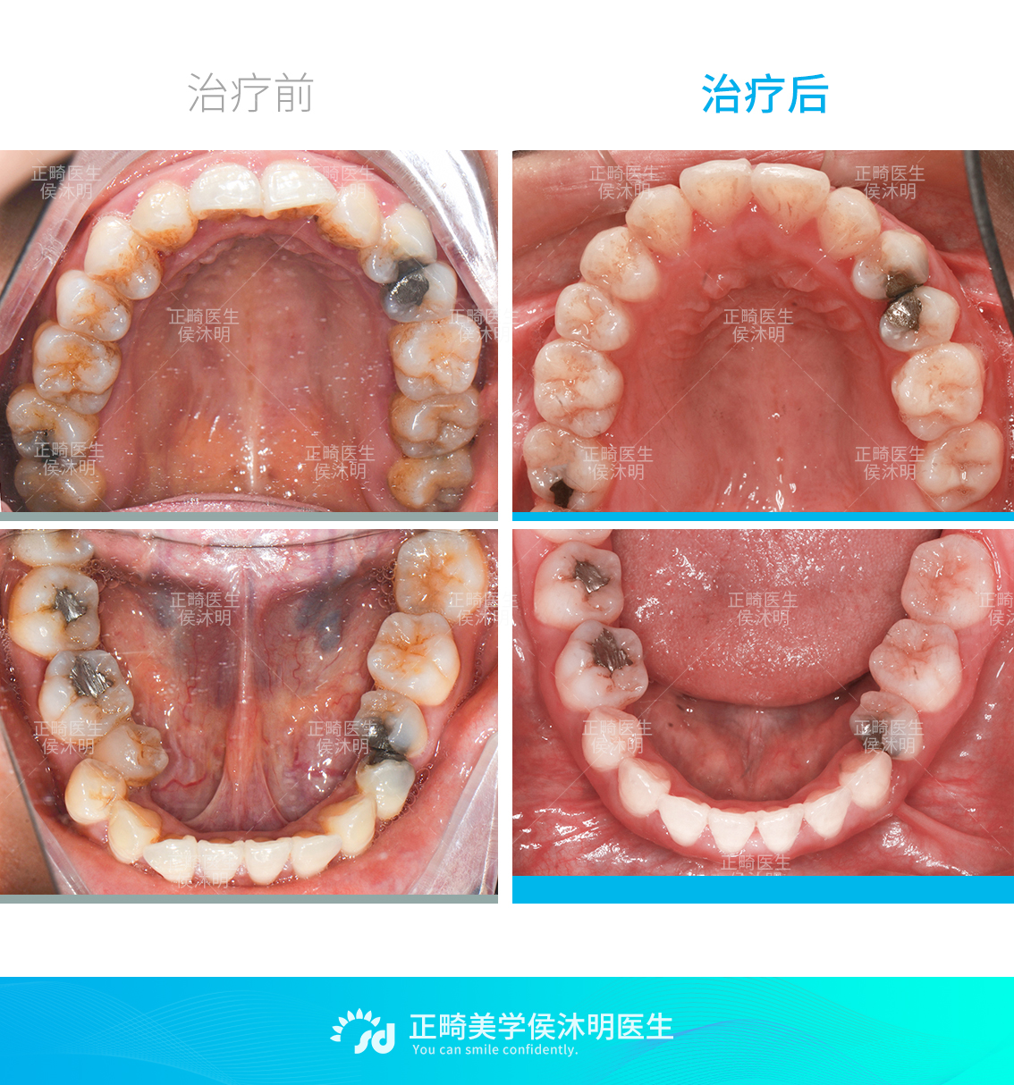 融合牙有什么危害图片