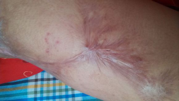 烧伤疤痕能修复好吗?