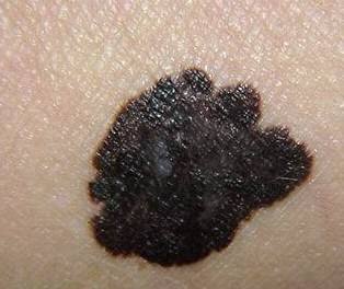 若青春期后黑痣显著增大或在平的黑斑上出现突起的丘疹,或黑痣疼痛不