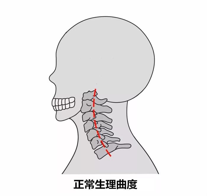 正常情况下,为维持人体直立和躯干平衡,颈椎呈向前凸出的弧度,如果没