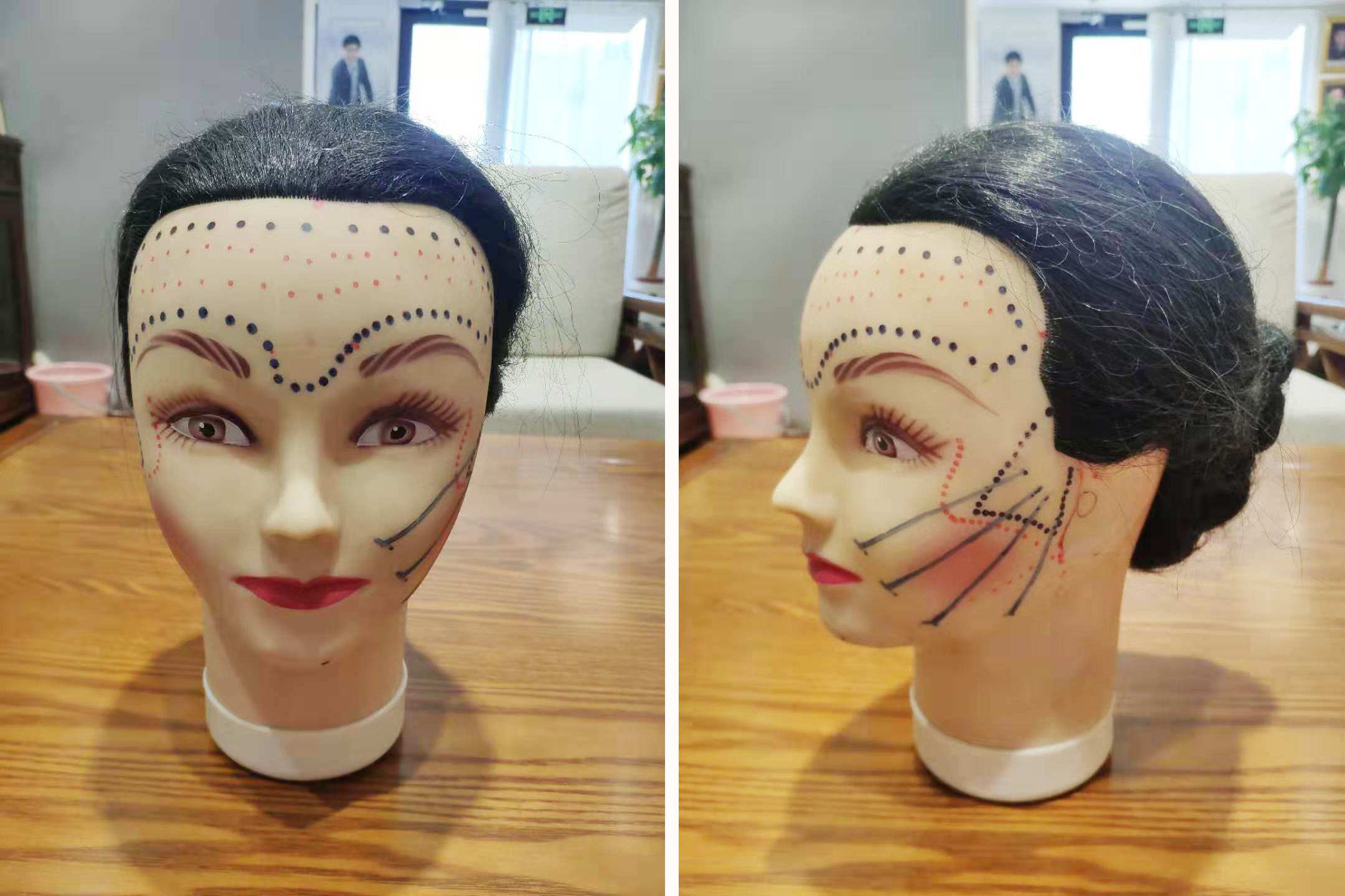 锯齿线悬吊提升/除皱手术材料有哪些特点?