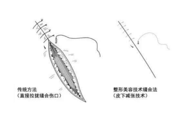 皮下缝合用什么线论腹壁整形中的减张缝合法！_https://www.jmylbn.com_新闻资讯_第3张