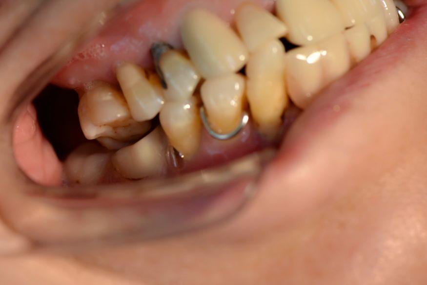 牙齿松动吃饭太遭罪,能拔吗?