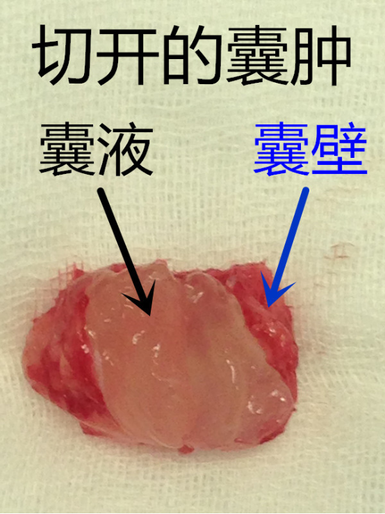 腱鞘囊肿内部液体图片图片