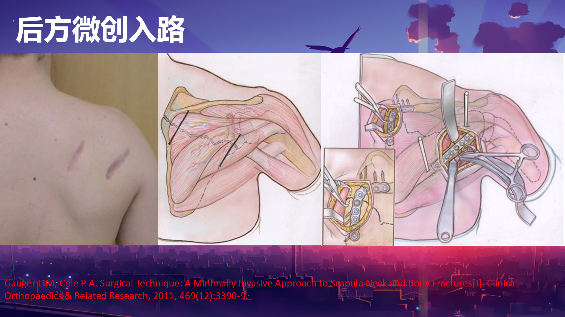 肩胛骨手术入路图片