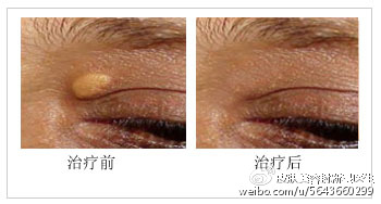 天网恢恢,疏而不漏,睑黄疣,快快如实招来