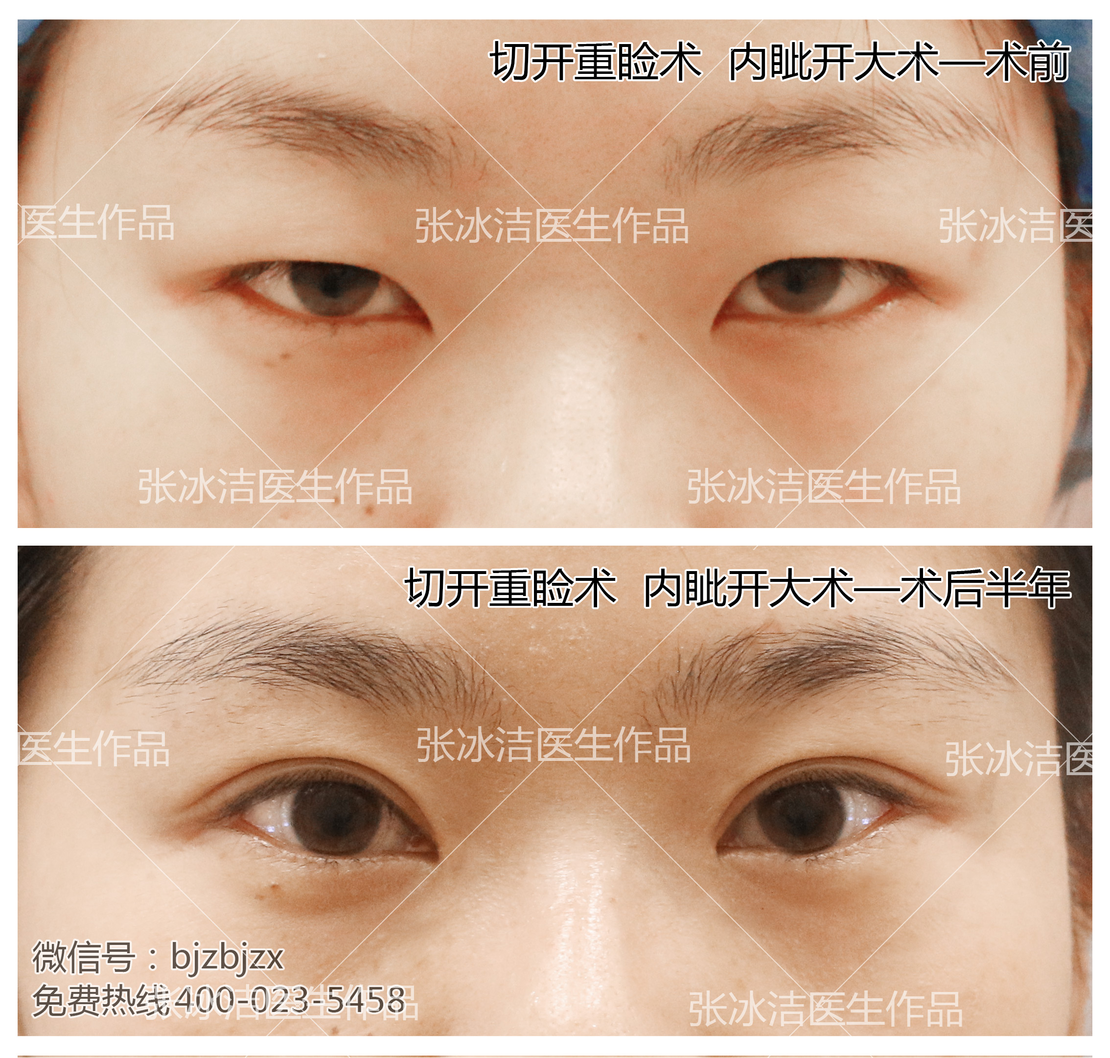 避免内眼角开大出现疤痕问题,一定要选择正规的医疗机构,有经验的医生