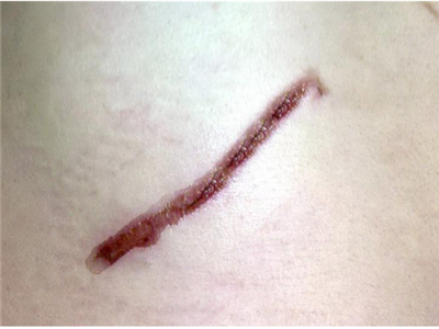 漂亮小姑娘不慎摔倒,腿上留下很长的疤,流下了伤心的眼泪