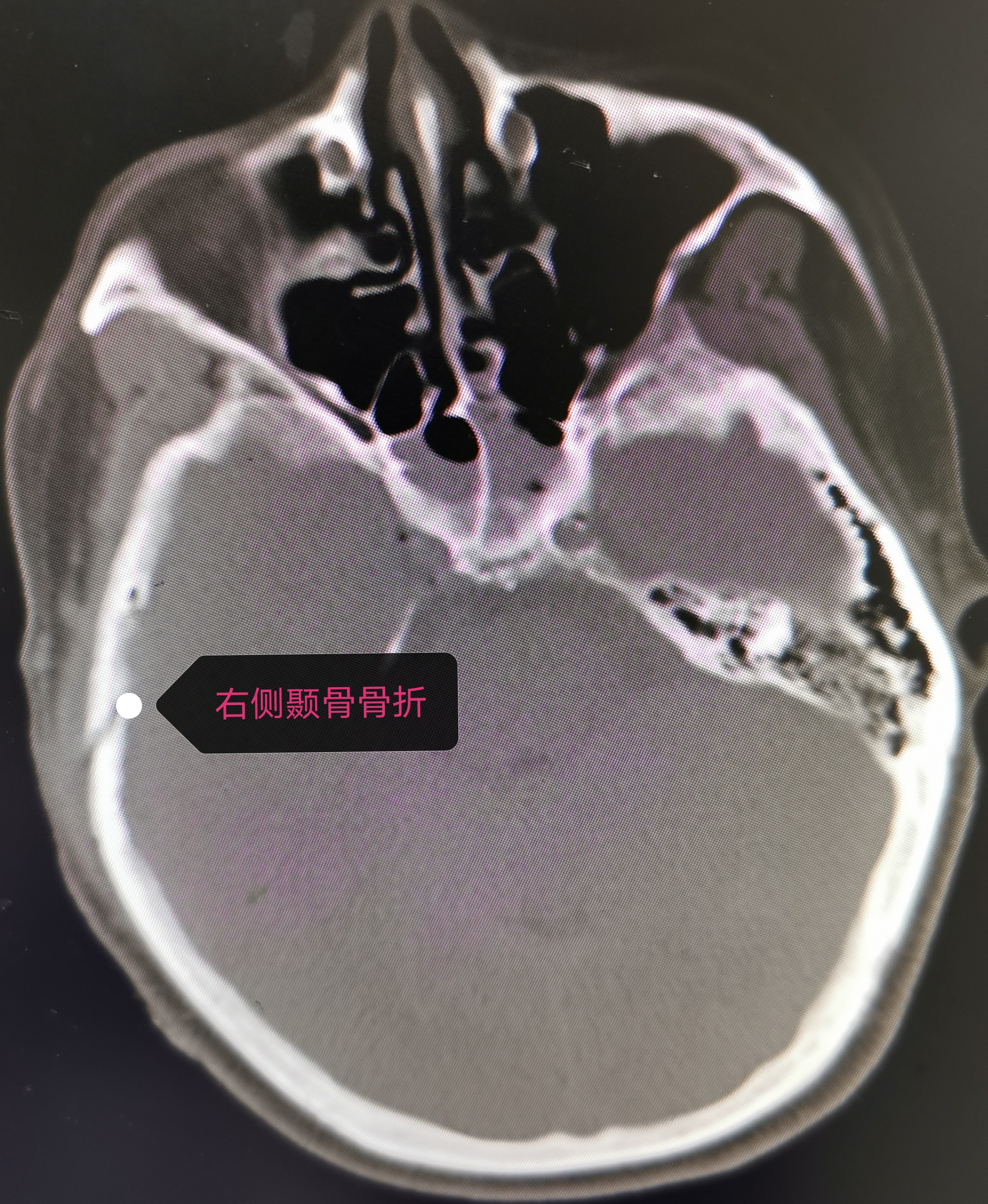 颞骨骨折需警惕硬膜外血肿