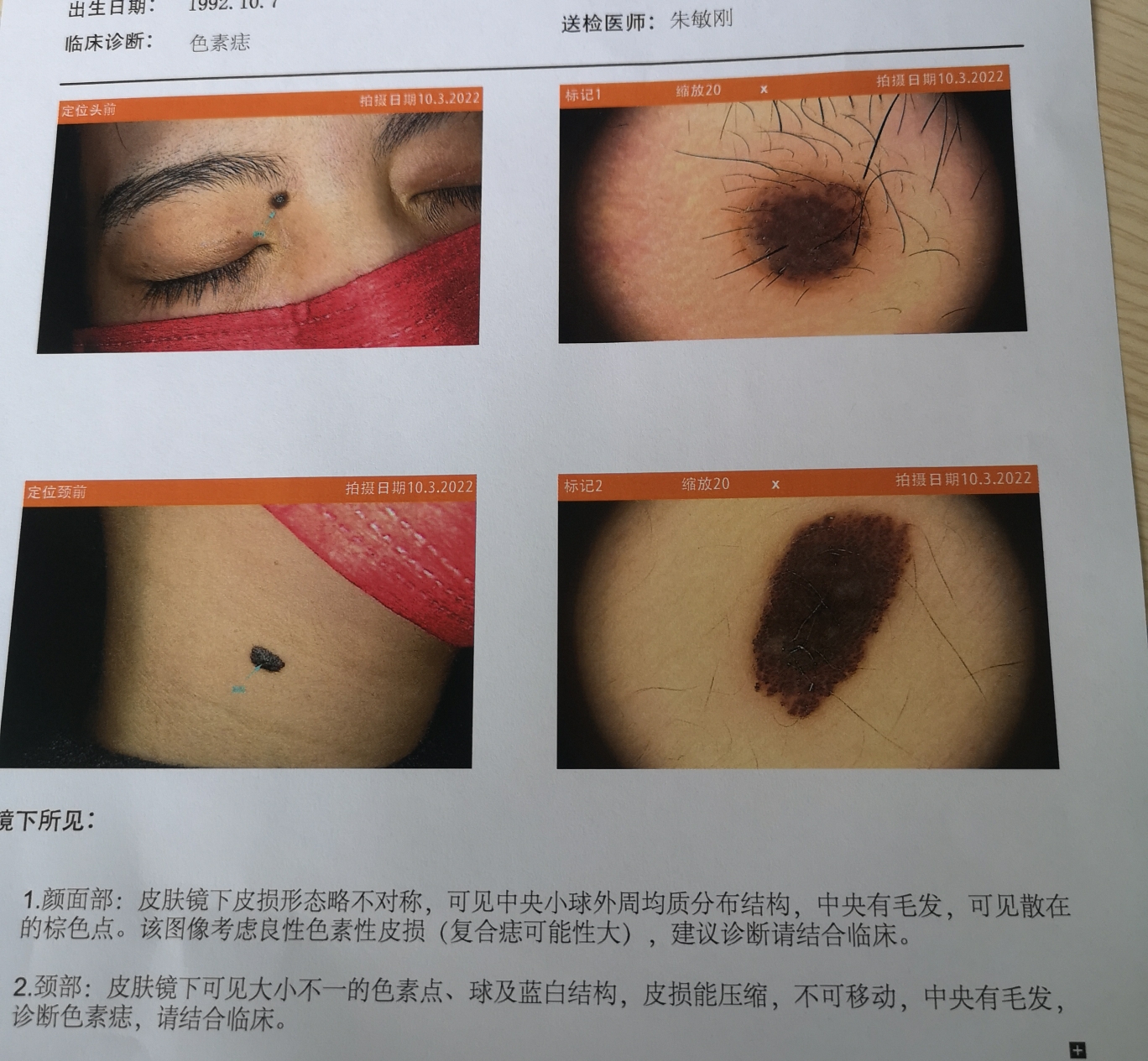先天性色素痣怎么处理？