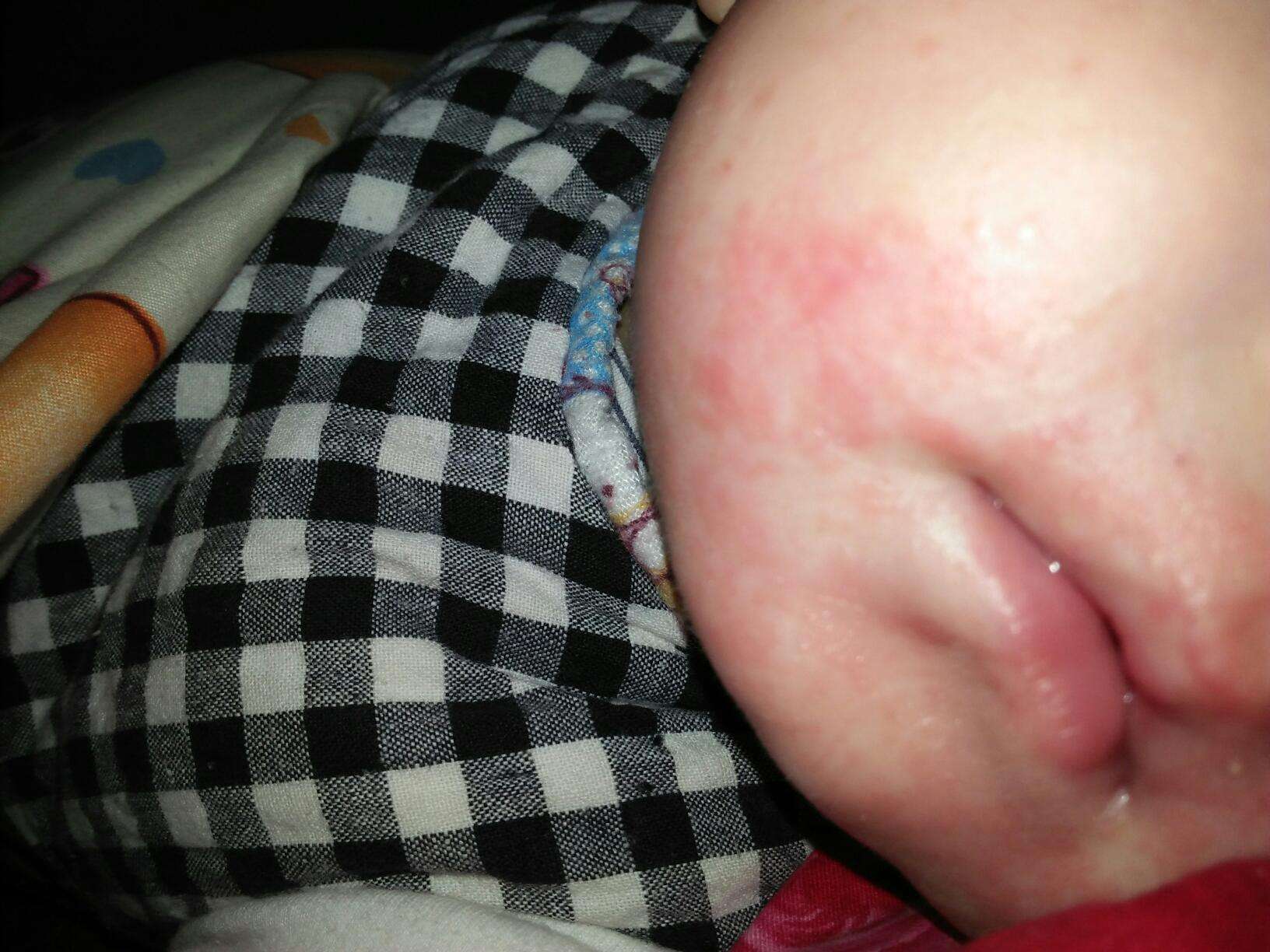 婴幼儿湿疹常见的诱发因素:1,皮肤干燥2,刺激物