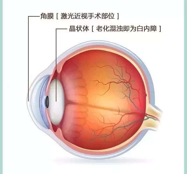 二三十岁做近视手术，老了以后眼睛会得白内障？