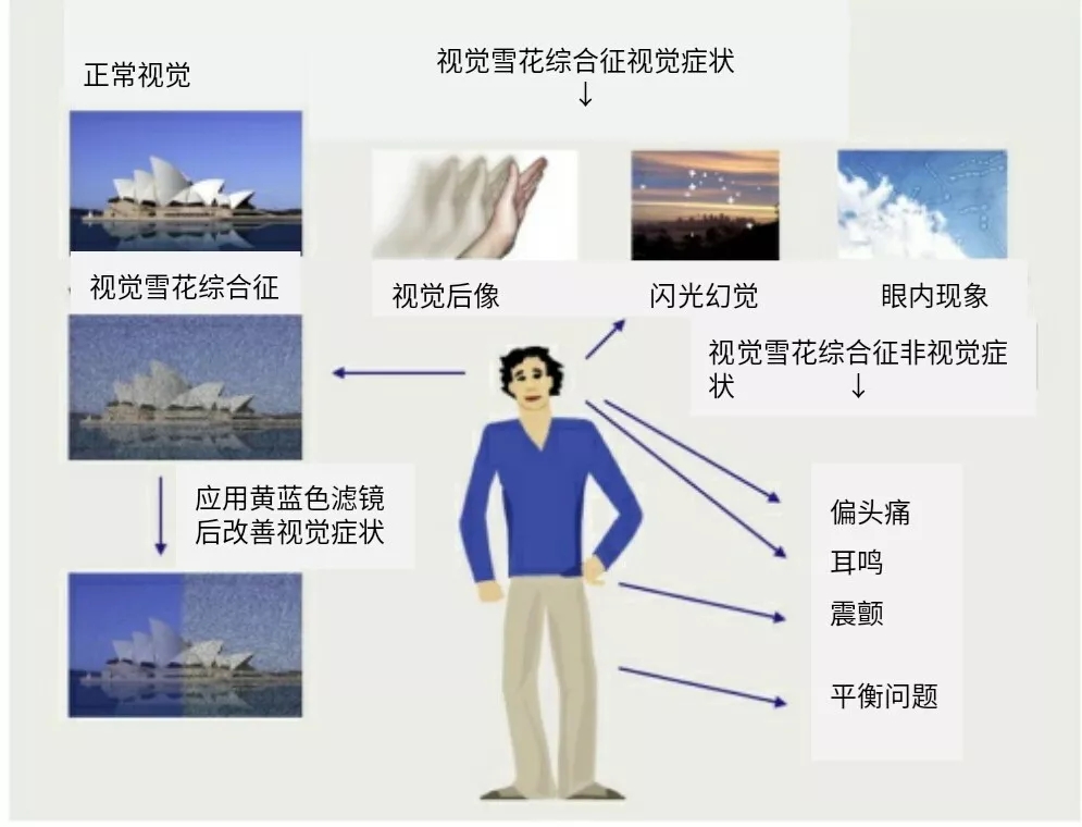 视觉雪花综合征