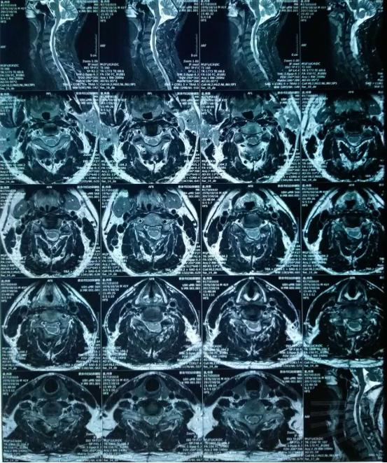 病例:颈部脊髓出现损伤手术后多久能缓解?