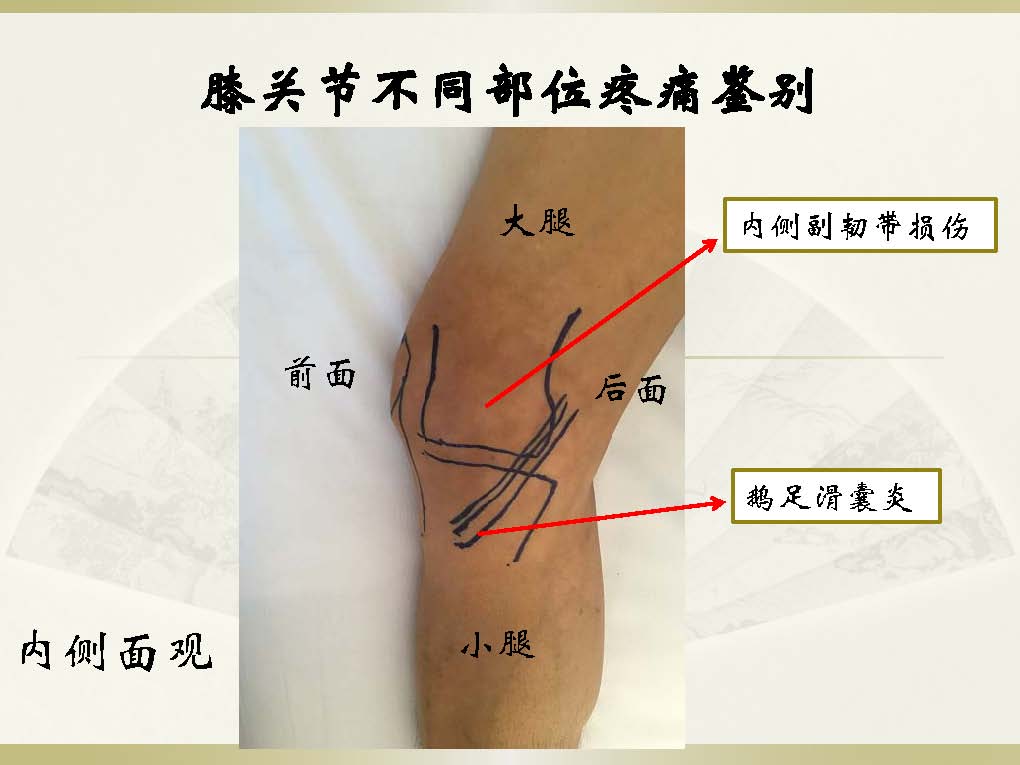 膝关节不同部位疼痛的鉴别