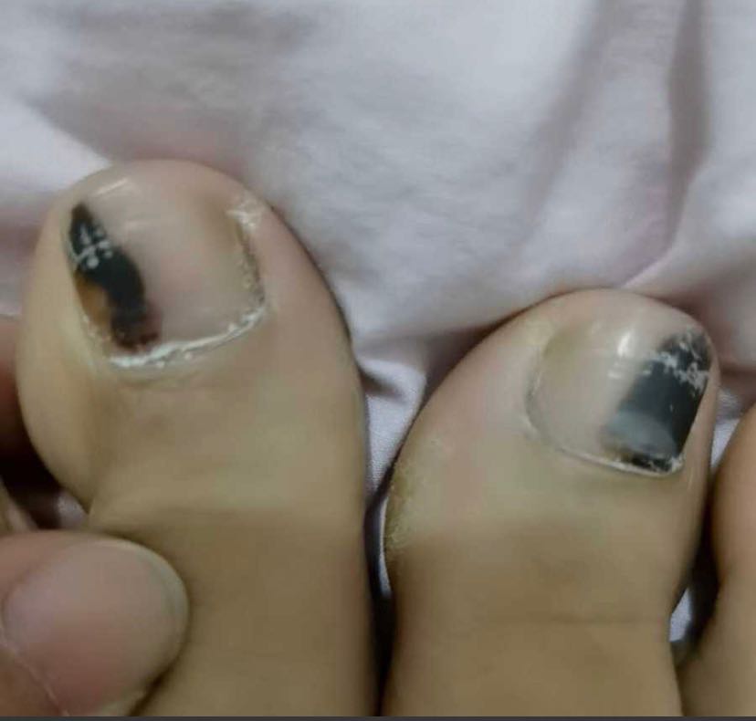 脚指甲黑色素瘤自查图片