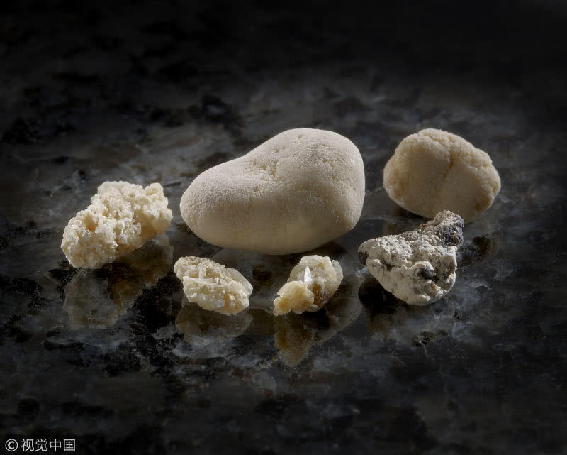 诊间日记:肾结石患者可以补钙吗?