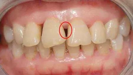 谈一下牙齿黑三角那些事