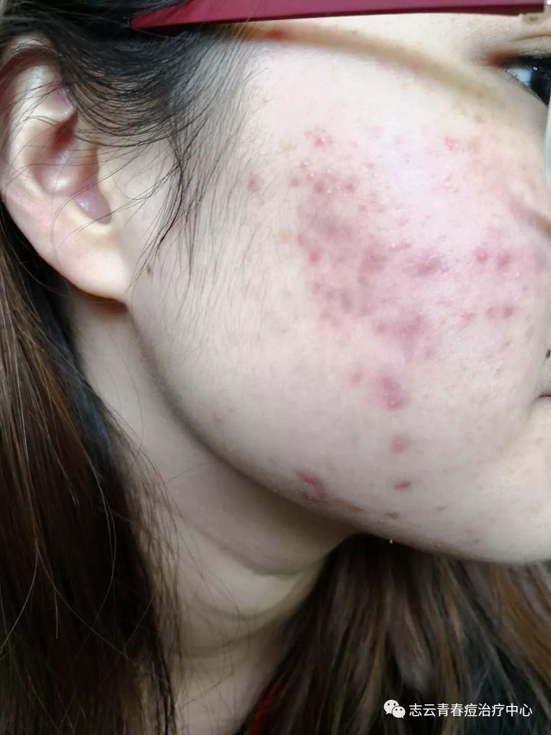 脸上痘痘的中西医分析