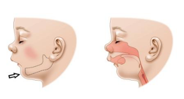 下颌发育不足,小下巴,俗称鸟嘴.