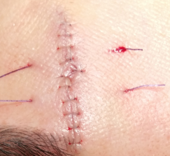 皮下缝合用什么线常用的疤痕切除术切口减张技术_https://www.jmylbn.com_新闻资讯_第4张