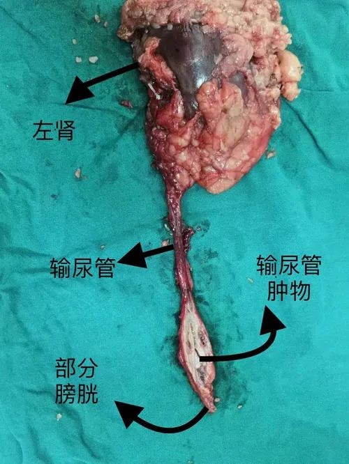 输尿管末端图片