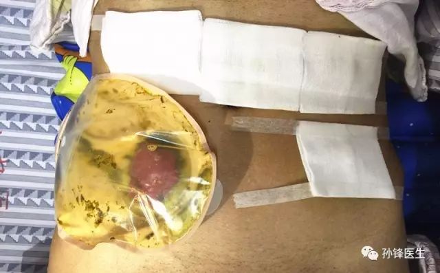 医学干货|面对十必做预防性造瘘的低位直肠癌患者,我毫不犹豫!