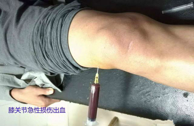 膝关节积液,有什么运动可以帮助恢复?