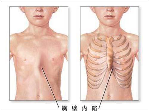 小儿漏斗胸的常见症状表现
