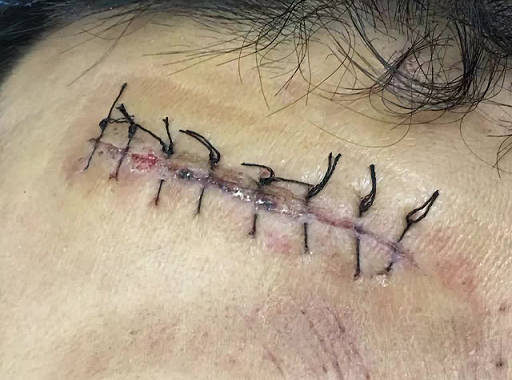 如下图所示,一旦发现这样的伤口缝合,请麻溜儿的找到专业的医疗机构