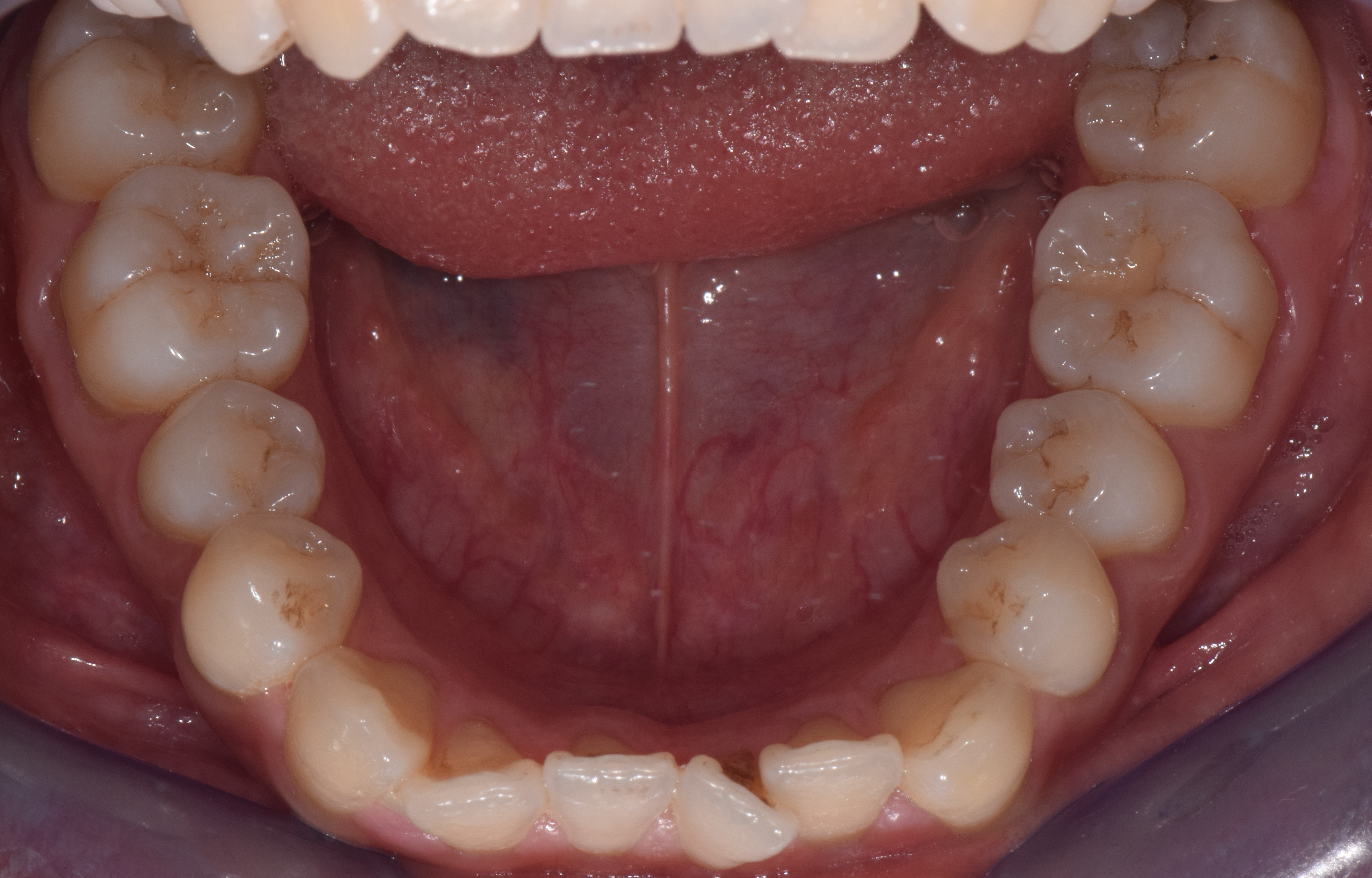 侧切牙垂直向开颌3mm;2,上颌相对下颌偏窄,只有磨牙有咬合接触,后牙